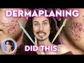 Did Dermaplaning Break You Out? 👀