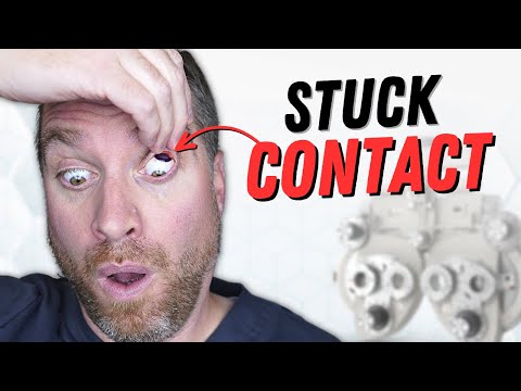 How To Remove A Stuck Contact Lens From Your Upper Eyelid!