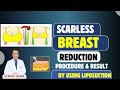 Scarless Breast Reduction Surgery By Using Liposuction Breast Reduction In Kolkata Dr PK Talwar