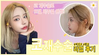 코 성형 3회차 재수술 후  리얼 후기 #잇츠비의원 #수술후기