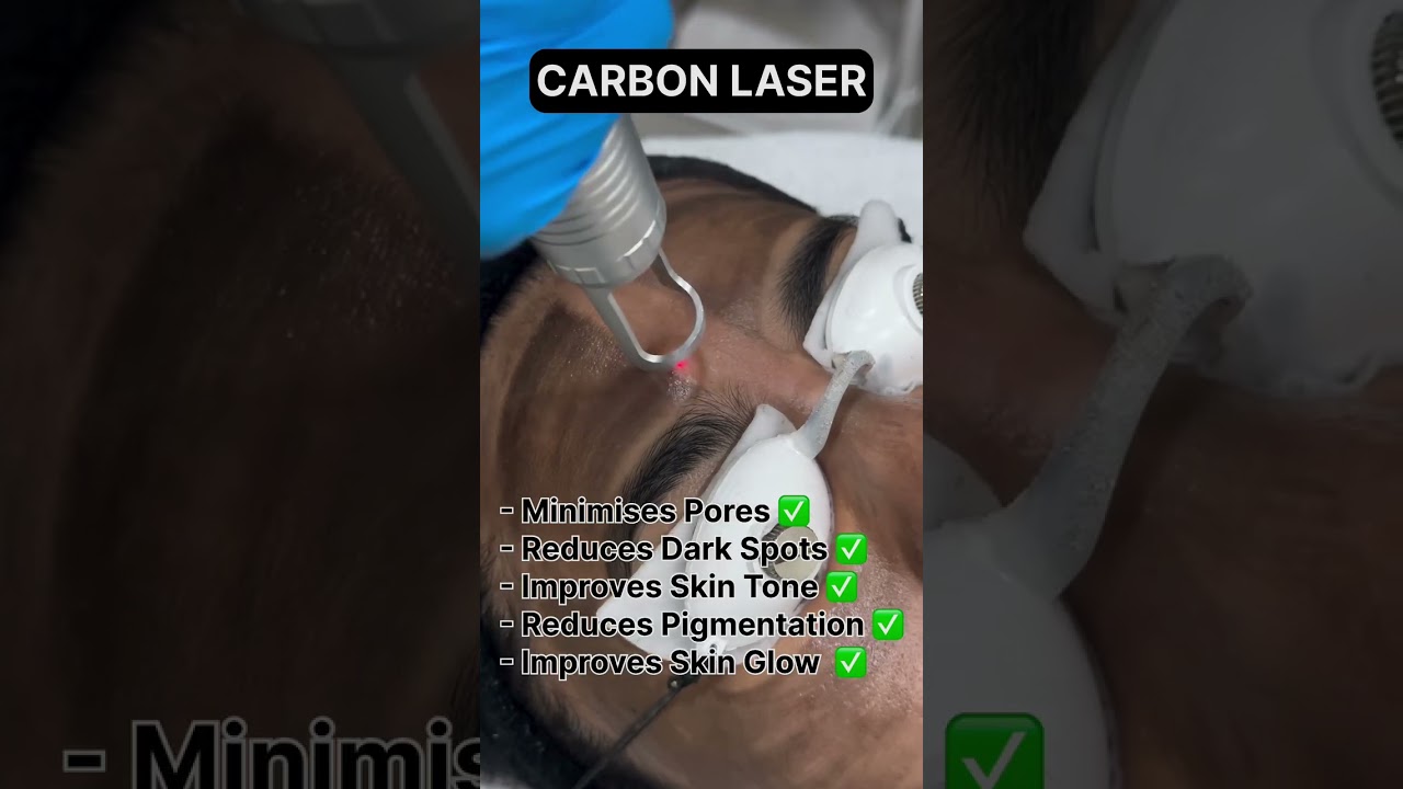 Carbon laser 💁🏼‍♀️