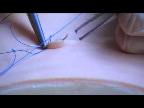 Subcuticular Suture Technique