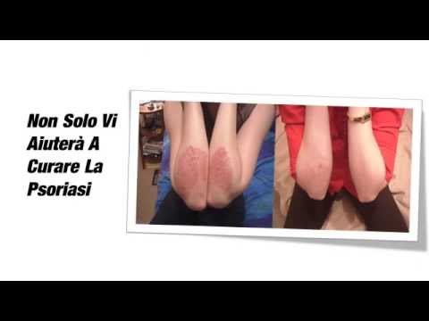 Metrogit da dermatite atopic Trattamento dindurimento di psoriasi