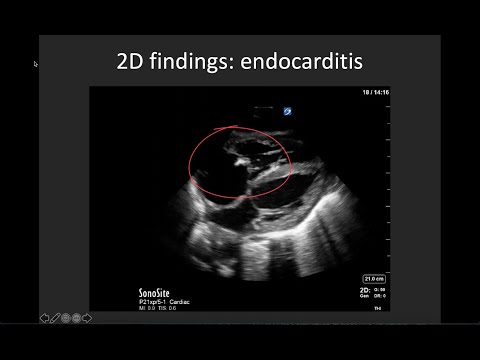 Basic Valve Evaluation with POCUS