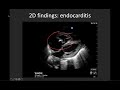 Basic Valve Evaluation With POCUS