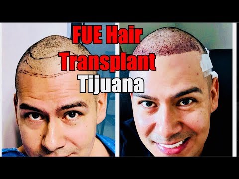 Best FUE Hair Transplant in Tijuana! Hair Medical...
