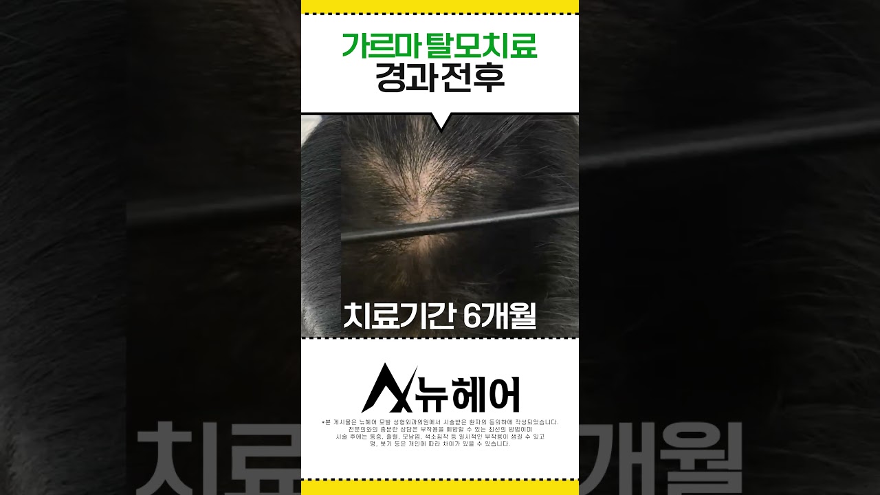 头顶脱发 发缝脱发！ 脱发治疗6个月后病情好转