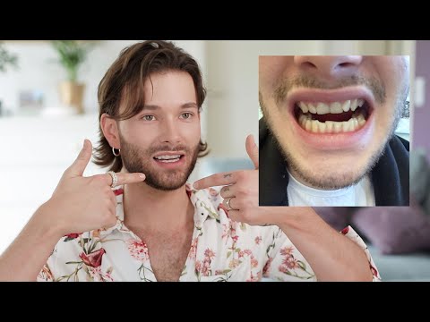 DR SMILE Stories: Schiefe Zähne richten ohne Zahnspange - Patricks Erfahrungen