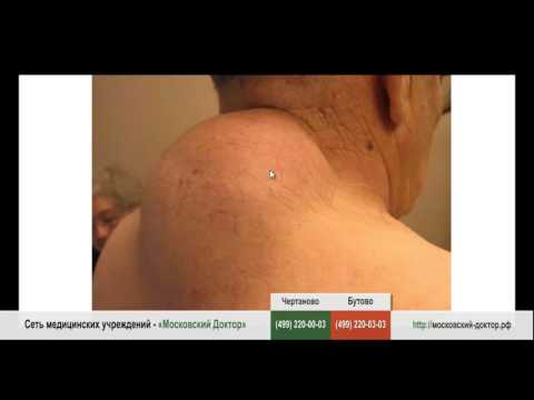 Артротомия сустава Хронический полиартрит коленных суставов