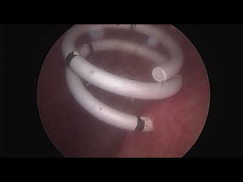 image-How do I know if my ureteral stent is infected?