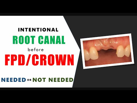 Celowe leczenie endodontyczne przed wykonaniem korony protetycznej - tak czy nie?