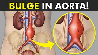 Aortic Aneurysm Explained: Symptoms, Causes, and Treatments