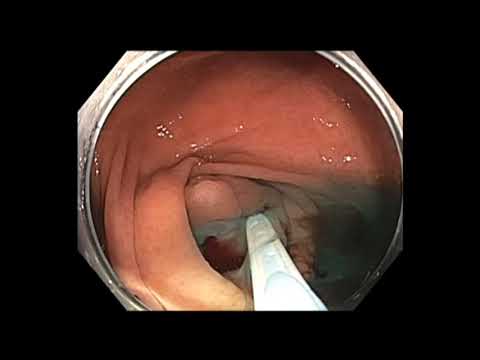 Coloscopie: ablation du polype de l'orifice appendiculaire