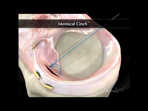 Szycie łąkotki - artroskopia kolana