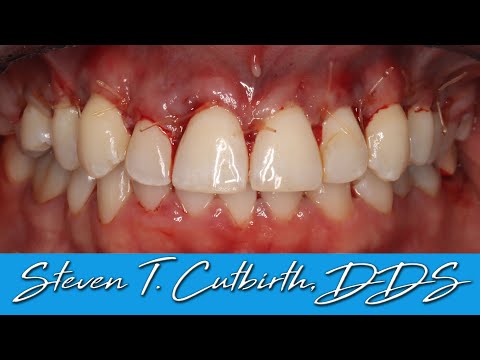 How to Suture a Crown Lengthening Surgery
