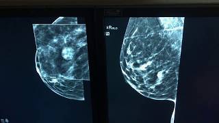 Ryan Polselli Importance of Prior Mammograms