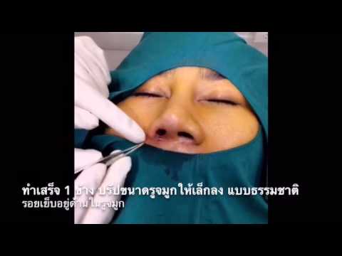 โบท็อก ปีกจมูก