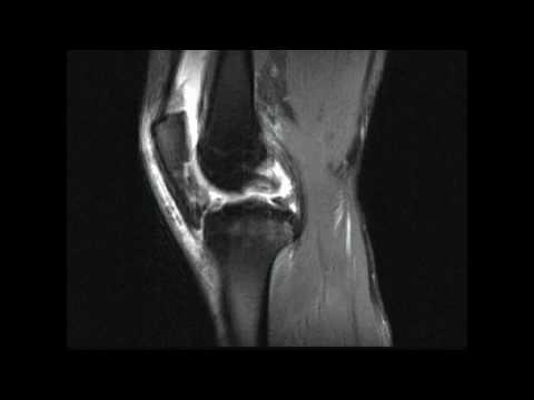 Osteochondrose Symptome Rippen Gelenkschmerzen geschwollener Knöchel auf den Beinen