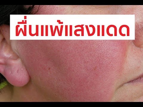 กลากไวน์แดง หนังราคาคิงโรคสะเก็ดเงิน