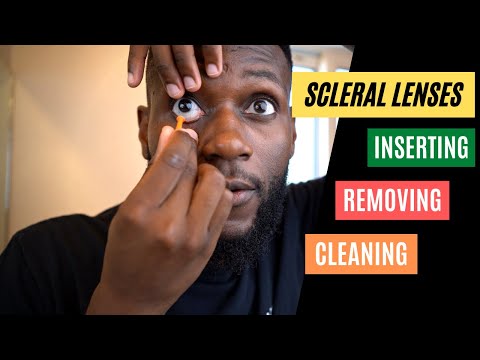KC Hacks! - Inserting, Removing And Cleaning Scleral Lenses  || Scleral Lenses