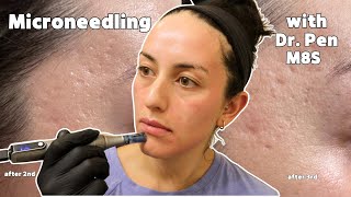 Dr. Pen Microneedling at Home for Acne Scars | Before & After Photos