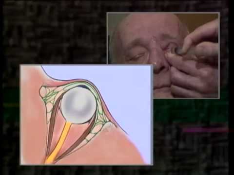 Regional Anesthesia for Intraocular Surgery