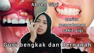 Download lagu Cara Menyembuhkan Sakit Gigi Gusi Bengkak dan Bernanah mp3