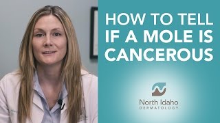 How to Tell if Your Mole is Cancerous - North Idaho Dermatology