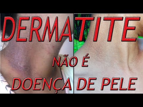 Trattamento di succo di ravanello di psoriasi Cura di psoriasi e la sua descrizione