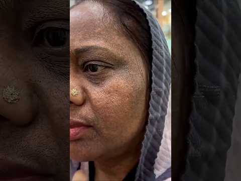 7Days Dark Spots, Melasma & Pigmentation Removal Challenge | Get Clear Glowing & Spotless Skin