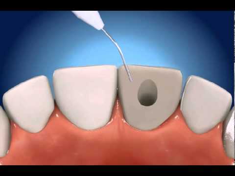 Root Canal Therapy (RCT) - The Gentle Dentist