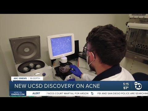 In-Depth: UCSD discovery could change acne treatment