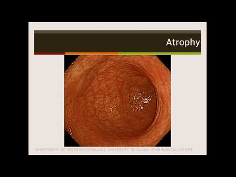 Strategies for Gastric Cancer Screening and Treatment of Early Neoplasia –2020 Gastric Cancer Summit