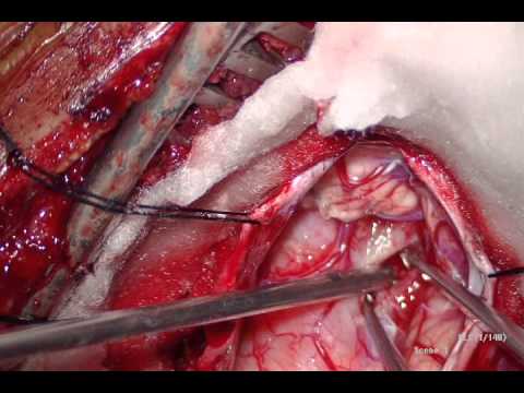 Dorsal Brainstem Glioma