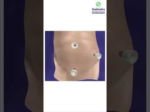 APPENDIX REMOVAL THROUGH LAPAROSCOPY | BEST SURGEON AT SHUBHECHHA HOSPITAL