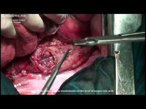 Coloplasty for Cardioesophageal Junction Cancer