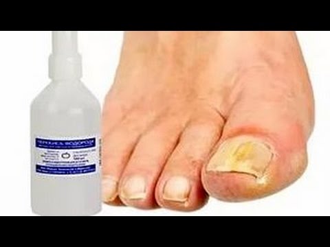 Klotrimasol flüssig bei gribke der Nägel Als gribok auf den Händen die Behandlung zu behandeln