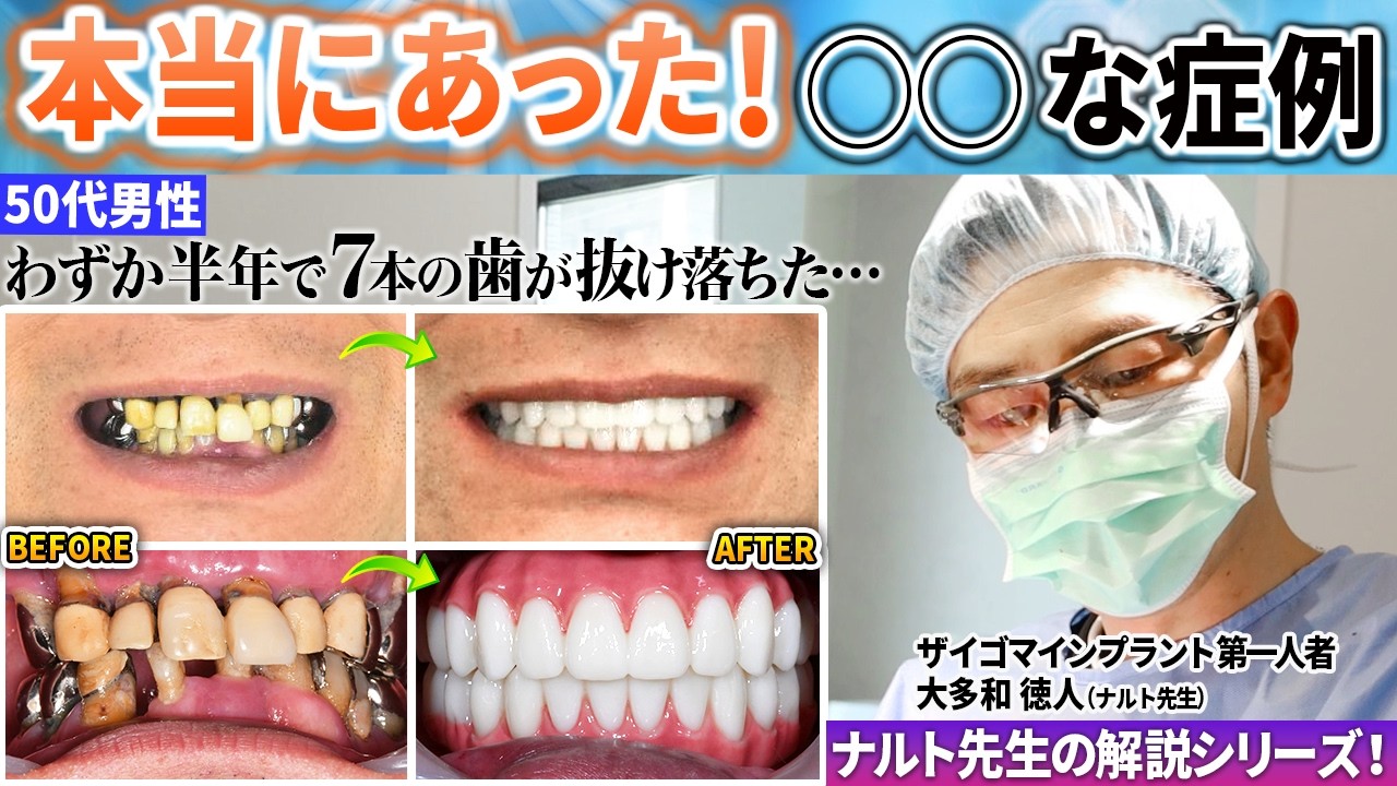 オールオン4ザイゴマなら1日で歯が入る！他院でインプラント自体が無理と言われた男性患者をナルト先生が治した物語始まります！本当にあったシリーズ