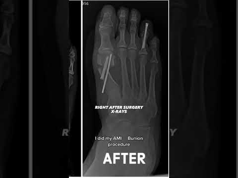 Bizarre Bunion & Hammertoe Treatment – Must Watch!