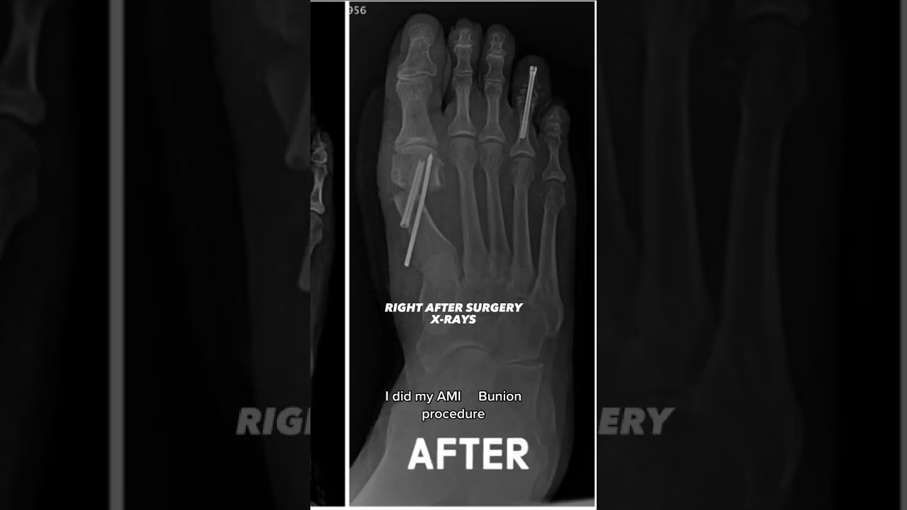 Bizarre Bunion & Hammertoe Treatment – Must Watch!