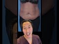 Great Tummy Tuck Results By Dr Youn Tummytucksurgery Tummytuckbeforeandafter Confidence Happy