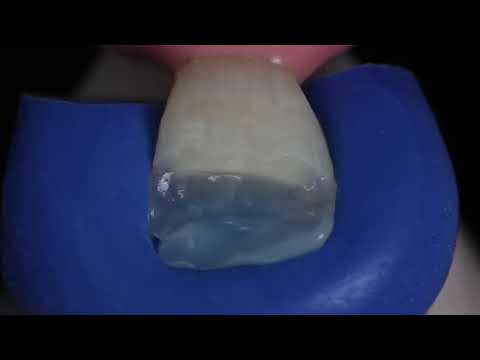 Ivoclar IPS Empress Direct – For highly aesthetic restorations
