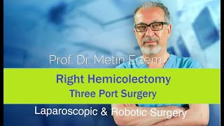 Miniaturka - Right Hemicolectomy. Three port surgery. Metin Ertem MD.FACS