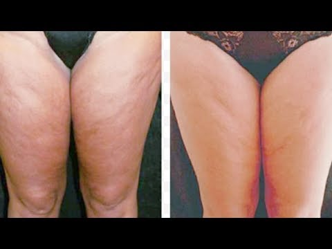 Yang produk harus dibuang untuk menghilangkan lemak perut wanita Cara termurah untuk menurunkan berat badan