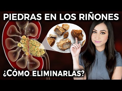 KIDNEY STONES: How to GET RID of them? What SYMPTOMS do they cause?👩🏻‍⚕️ @DraPauZuniga