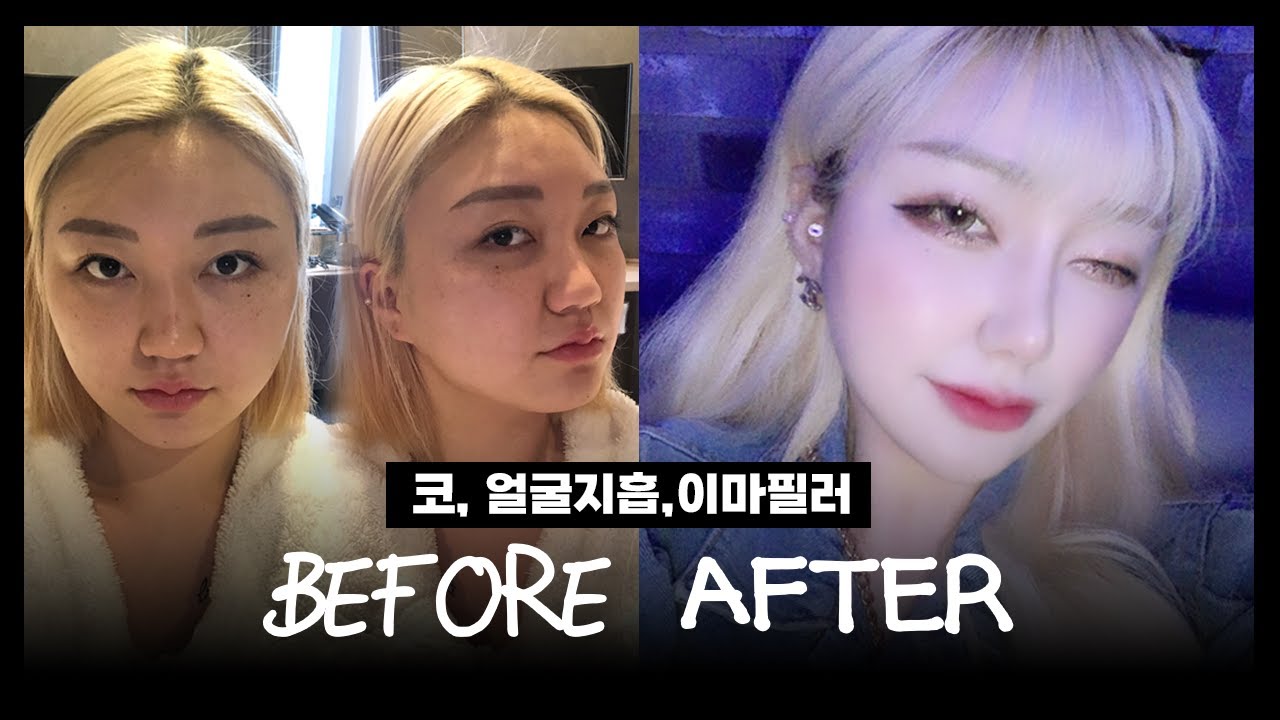 [브이로그] 최대한 화려하게 해보는 수술 ?코성형, 얼굴지흡, 이마필러?