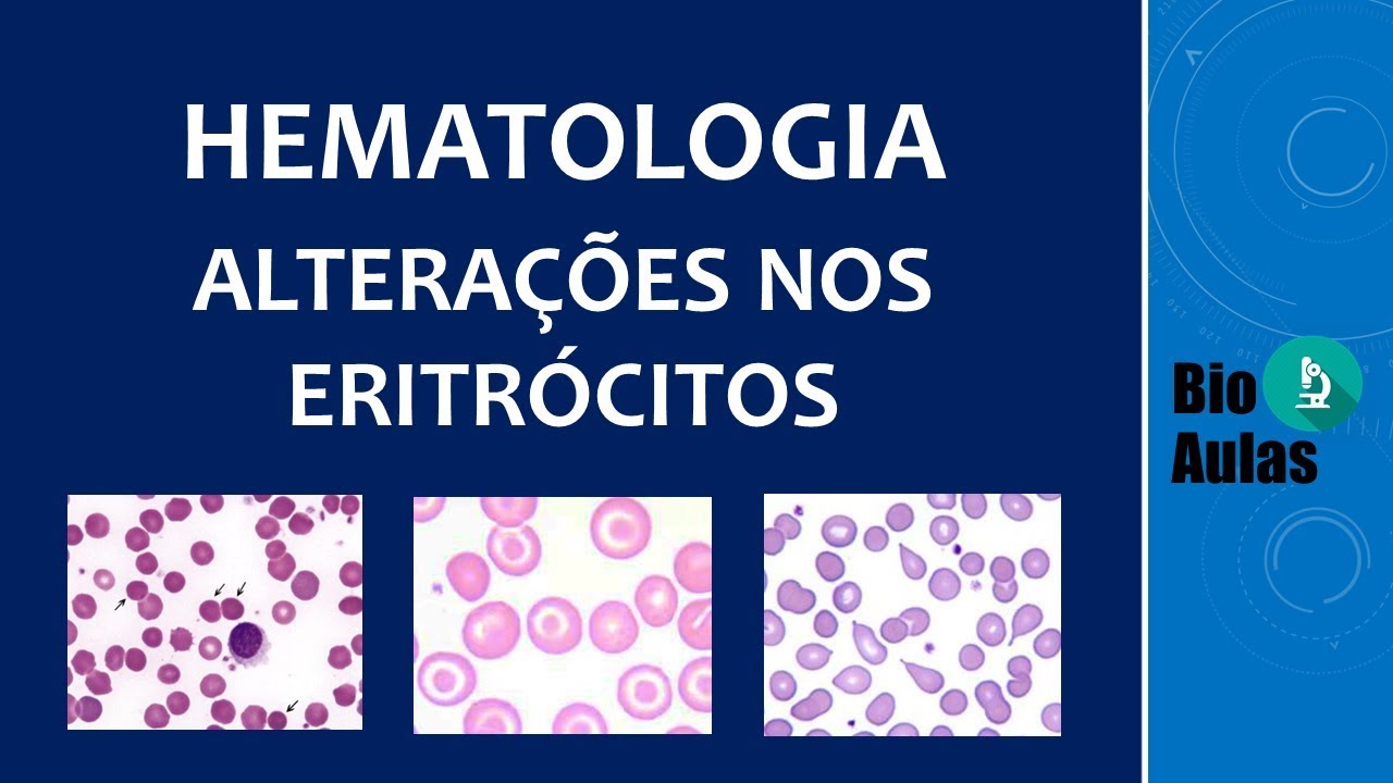 Anisocromia, Anisocitose e Poiquilocitose: Alterações no Hemograma (Hematologia) - Bio Aulas