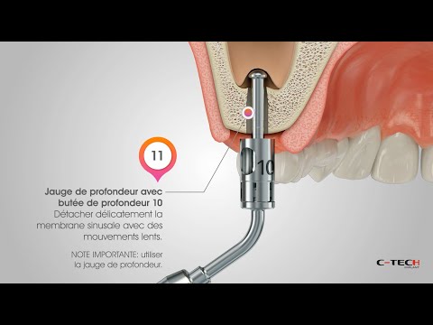 Crestal Sinus Lift - FRA