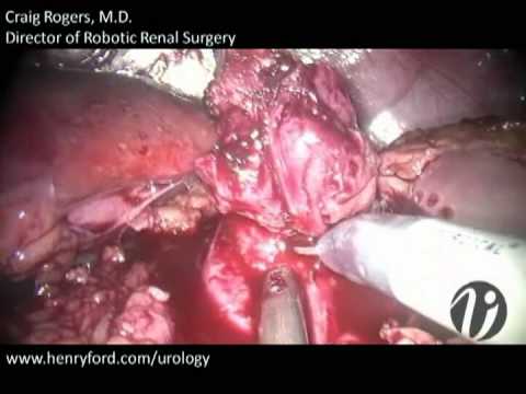 Robotic Partial Nephrectomy - Step 7: Tumor Excision