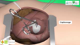 Surgery of the Hydatid Cyst  Barrett's Method - Shorts
